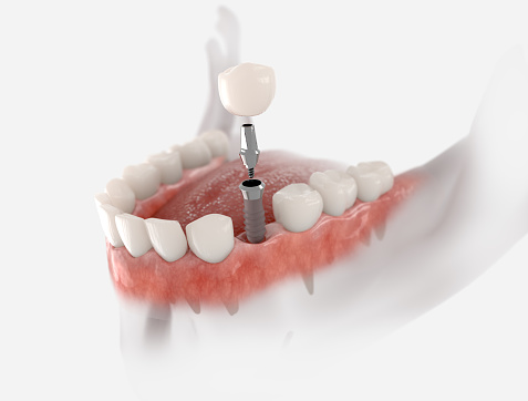 Can a Dental Implant Be Done in One Day?