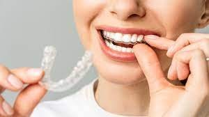 Creating one of a kind smiles with braces and aligners