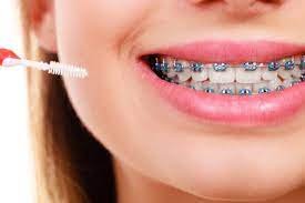 Tips to Ensure You and Your Braces Have a Wonderful Relationship